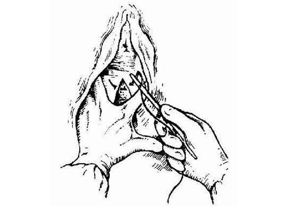 关于会阴侧切的真相，医生不一定会全告诉你！