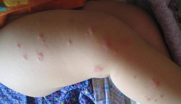 回老家身上长红疙瘩怎么回事很痒,五岁小孩身上起红疙瘩很痒怎么办