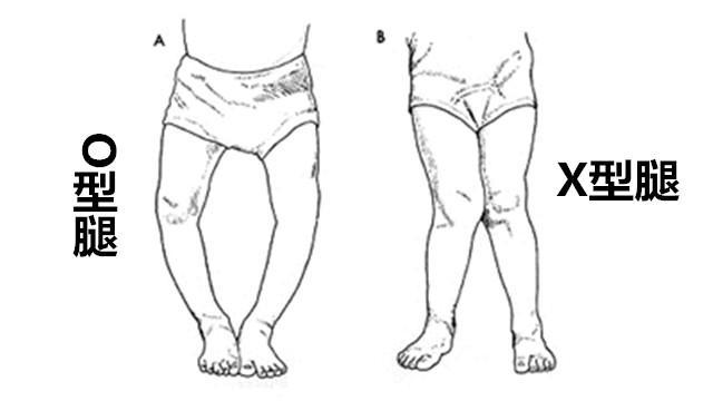 女儿o型腿怎么改正,罗圈腿和o型腿能看好吗
