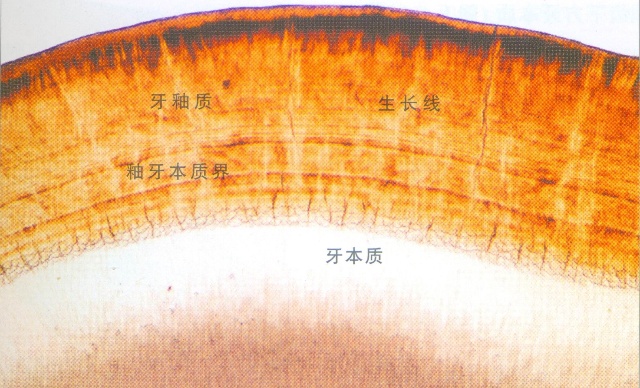 牙釉质磨损遇冷热硬都疼,牙釉质有隐裂怎么办