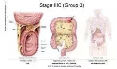得了直肠癌怎么知道,你了解结直肠癌吗
