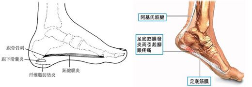 足跟痛为什么反复发作难治愈,足跟痛反复发作怎么办