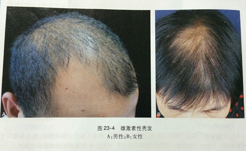 黑芝麻每天吃多少合适治疗脱发 (脂溢性脱发吃黑芝麻有效吗)