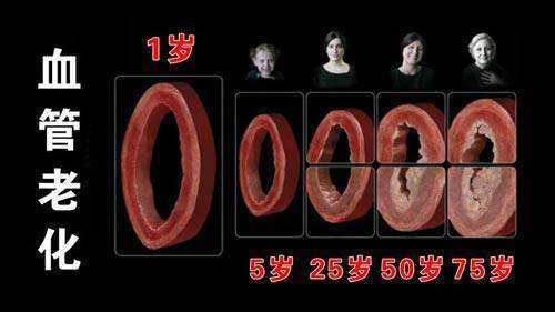 颈动脉缺血引起脑供血不足怎么办,颈动脉斑块会引起脑中风吗