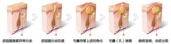 脸颊两侧反复长痘怎么调理,脸颊两侧长痘硬硬的摸着疼