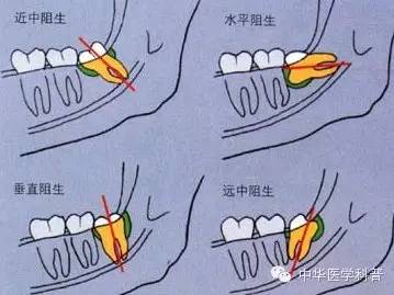 关于长智齿痛的心情说说,智齿说说朋友圈配图