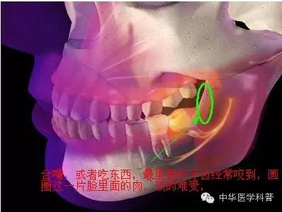 关于长智齿痛的心情说说,智齿说说朋友圈配图