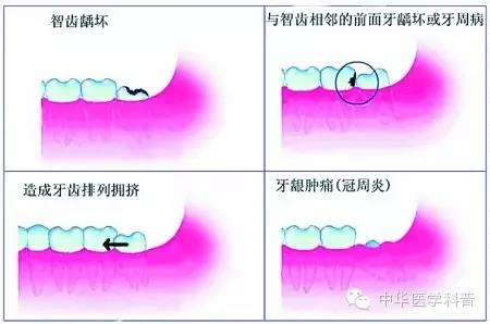 关于长智齿痛的心情说说,智齿说说朋友圈配图