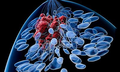 雌激素受体阳性的乳腺癌应如何治疗？