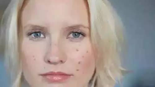 祛痘印简单不花钱小妙招,去痘印最有效的方法值得收藏
