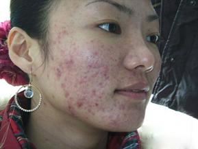 战痘的小秘诀,战痘的血泪史完整版