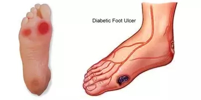 糖尿病足溃烂不再渗出是好转了吗,糖尿病足溃烂怎么办治疗要多久
