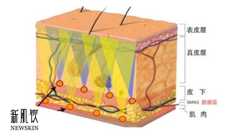 超声刀的效果好吗,韩国超声刀效果