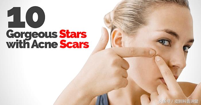 痘印痘痕怎么治,痘印和痘疤怎么治疗最好