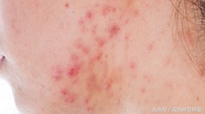 痘印痘痕怎么治,痘印和痘疤怎么治疗最好