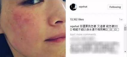 舒淇过敏修复方法,舒淇敏感肌自救方法