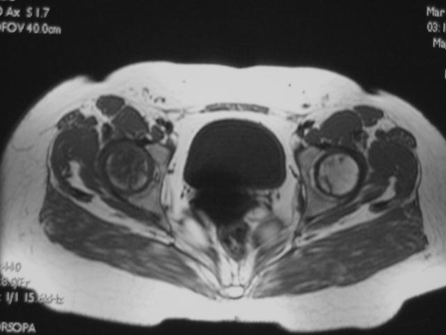 早期股骨头坏死核磁共振能看到吗,股骨头坏死修复过程的磁共振表现