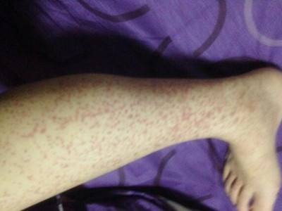 过敏性紫癜的危害有哪些,过敏性紫癜喝冷饮的危害