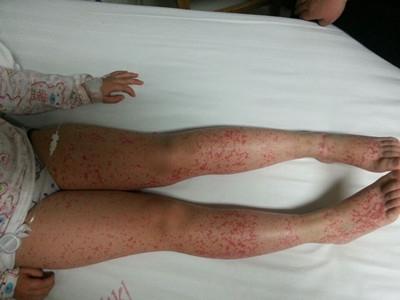 过敏性紫癜的危害有哪些,过敏性紫癜喝冷饮的危害