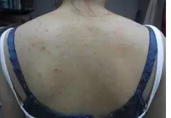 前胸后背长痘痘皮肤病,前胸后背长痘痘擦什么药