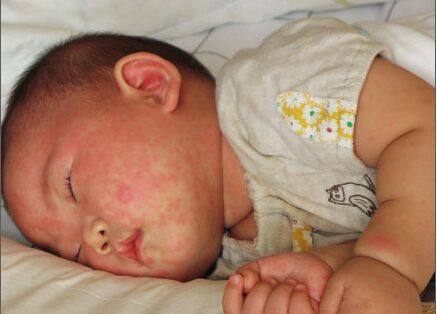 新生儿起红疹怎么回事,新生儿满月后满脸红疹