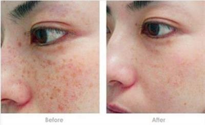 激光祛雀斑好还是药水祛雀斑好,激光祛雀斑哪种激光最好