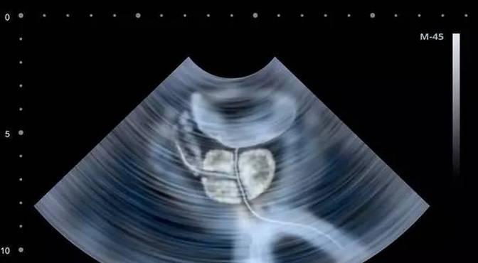 一张表看懂化验单,警惕前列腺的危害