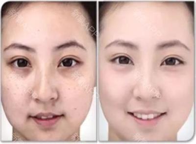 激光祛雀斑好还是药水祛雀斑好,激光祛雀斑哪种激光最好