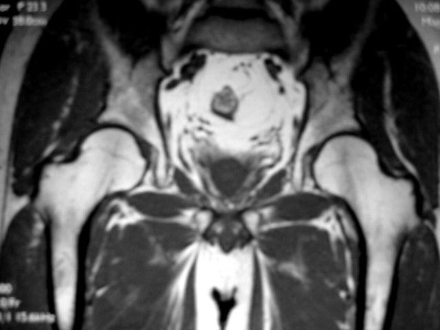早期股骨头坏死核磁共振能看到吗,股骨头坏死修复过程的磁共振表现