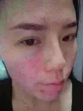 黄皮肤假货怎么识别,假货导致过敏