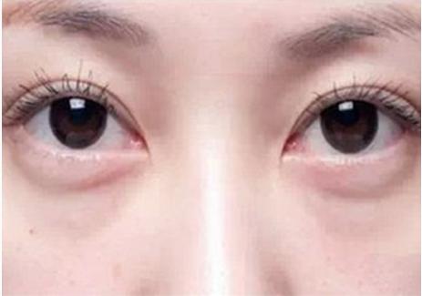 卧蚕和眼袋的区别你知道吗,卧蚕和眼袋的区别照片