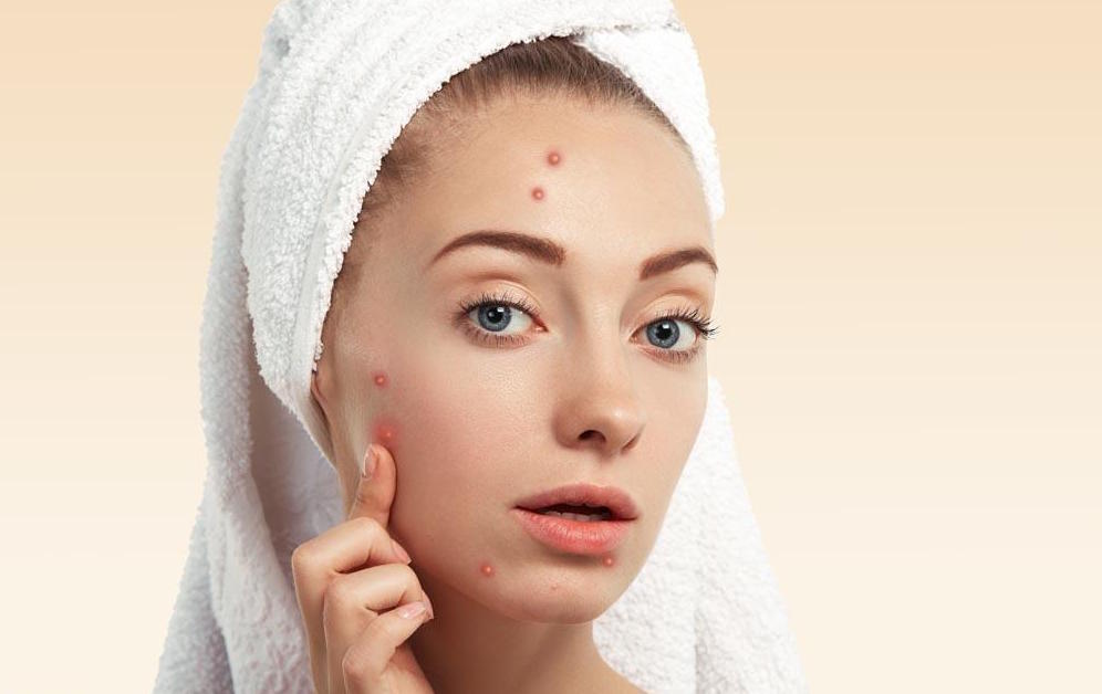 脸上痘痘告诉你身体哪里出了问题,脸上起痘痘对应的是哪里有问题