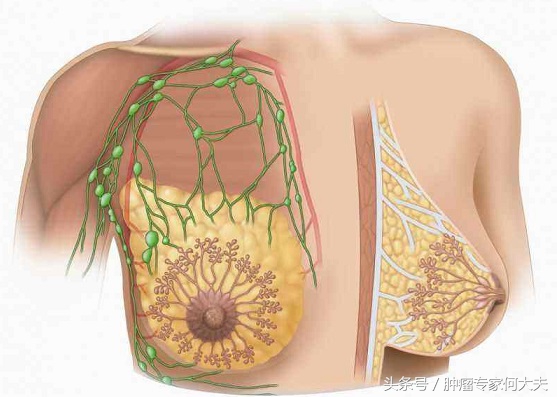 乳腺增生如何才能发展为乳腺癌,中医中药能治乳腺浸润性乳腺癌吗