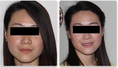 激光祛除雀斑真的有效吗,祛雀斑最有效的方法激光