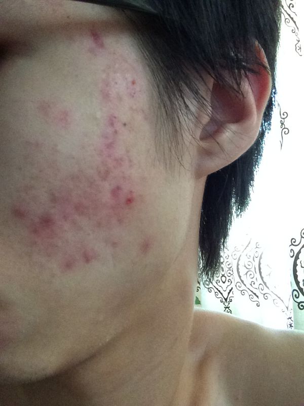 十年战痘血泪史详解,五年战痘经验分享