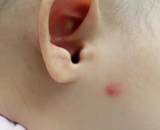 孩子小手被蚊子咬了后肿了,宝宝手被蚊子咬了个大包怎么办