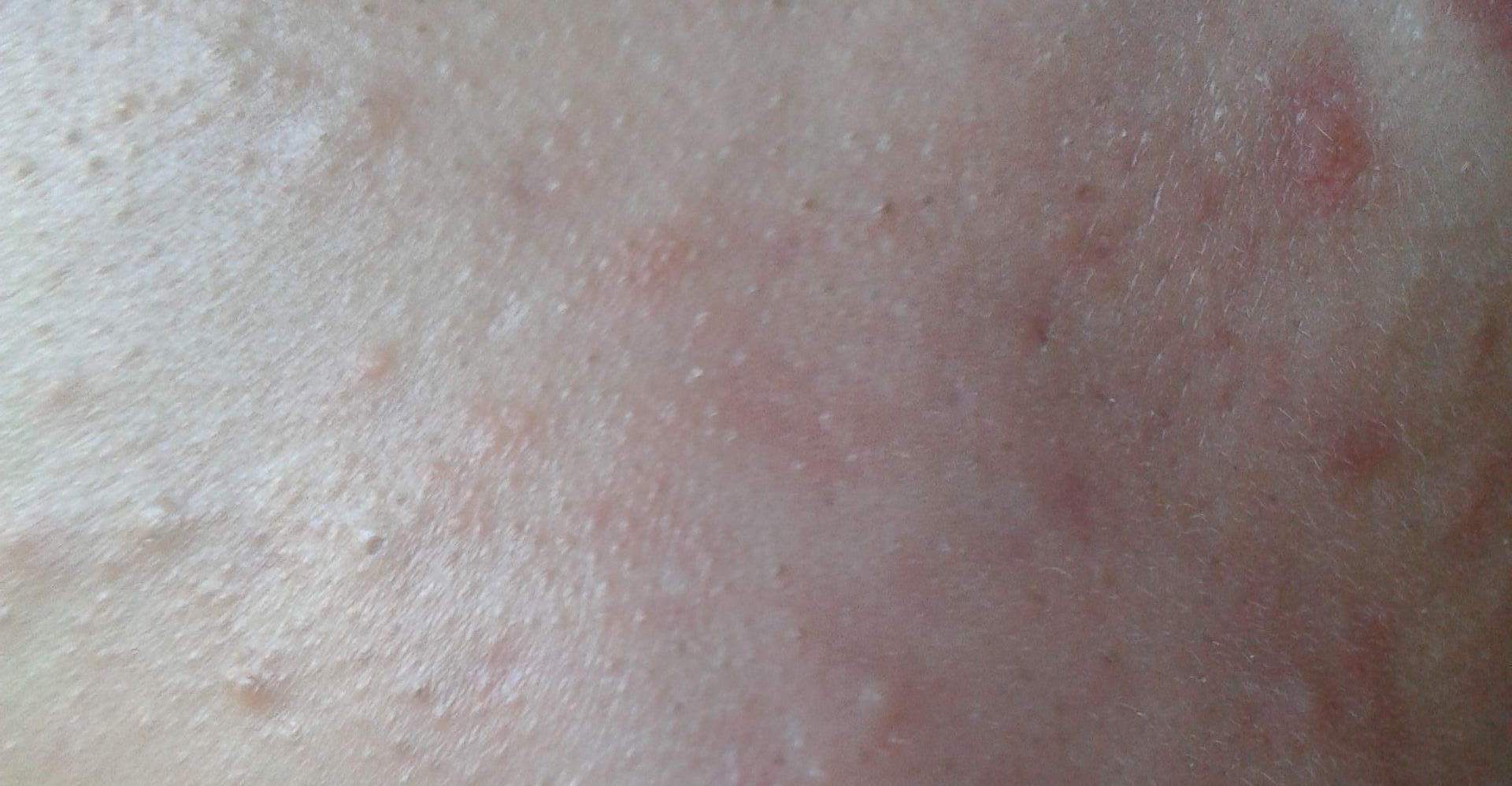 下巴长针眼大小白脓点是怎么回事,下巴有毛毛刺是什么原因