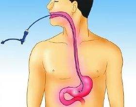 做胃镜很痛苦，有什么办法可以让做胃镜不再受罪？这两个办法好！