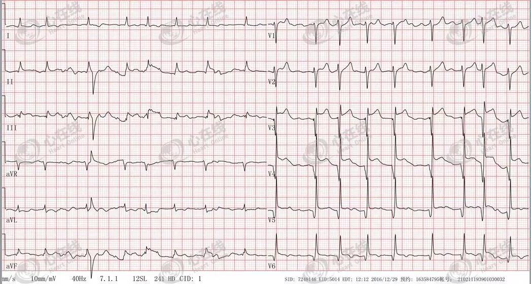 急性心肌梗死心源性休克时的处理,急性心肌梗死心源性休克最常见