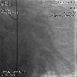 急性心肌梗死心源性休克时的处理,急性心肌梗死心源性休克最常见