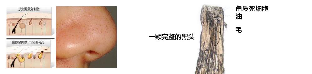 下巴长针眼大小白脓点是怎么回事,下巴有毛毛刺是什么原因