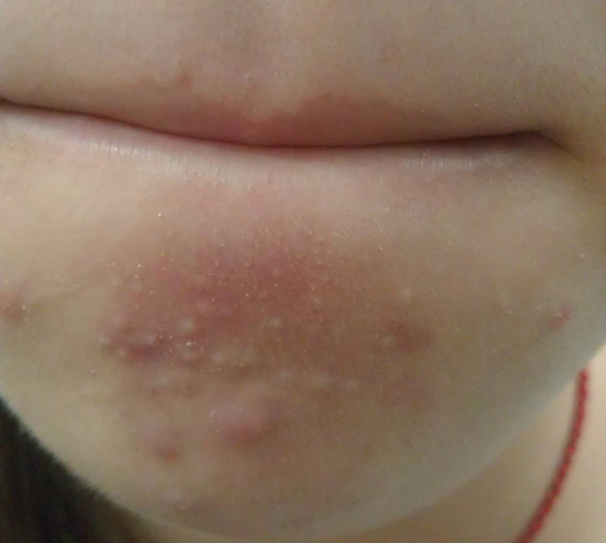 下巴长针眼大小白脓点是怎么回事,下巴有毛毛刺是什么原因