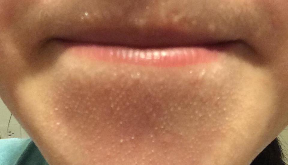 下巴长针眼大小白脓点是怎么回事,下巴有毛毛刺是什么原因