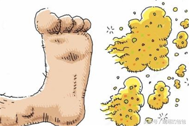 脚气脚底脱皮开裂,脚气脚底脱皮开裂流脓怎么办