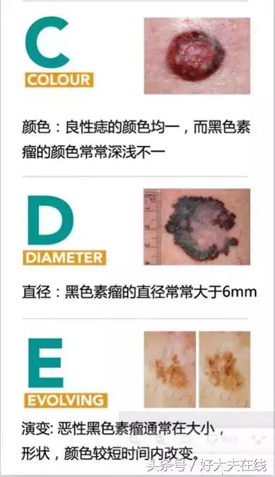 所有不规则的黑痣都是黑色素瘤吗,长多大的黑痣有可能是黑色素瘤