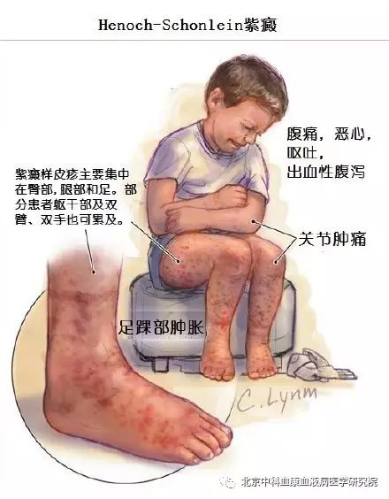 过敏性紫癜是否很难真正的痊愈,过敏性紫癜怎么久治不愈