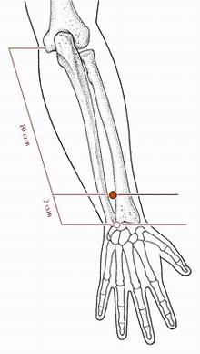 脊髓型颈椎病针灸治疗处方,神经根型颈椎病针灸绝技
