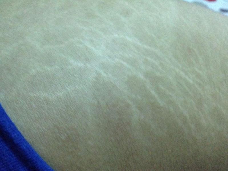 肥胖纹是不能消除的，只能淡化，跟着这5个方法在家也能改善