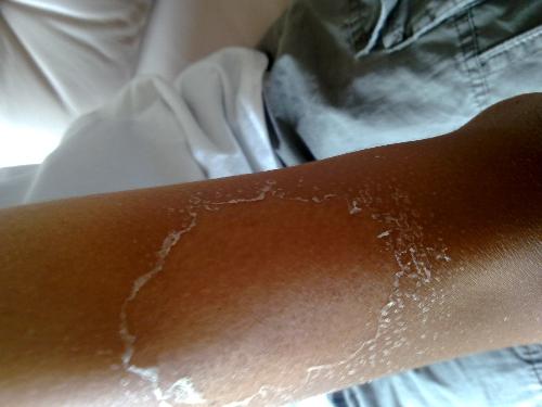 皮肤晒伤修复膏有用吗,皮肤晒伤修复膏