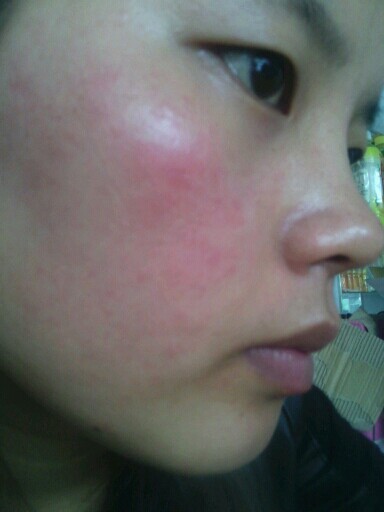 皮肤晒伤修复膏有用吗,皮肤晒伤修复膏